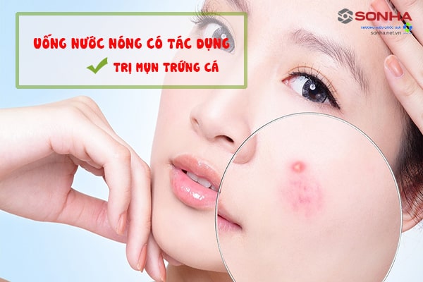 Uống nước nóng có tác dụng trị mụn trứng cá hiệu quả